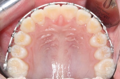 연산동덧니교정