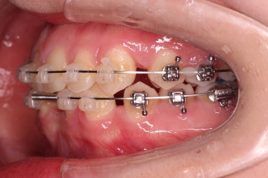 부산교정치과추천
