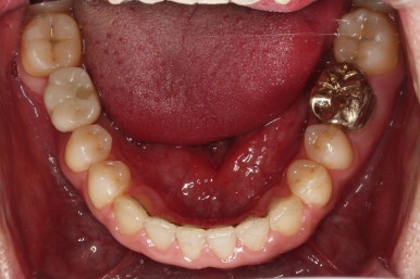 연산동임플란트