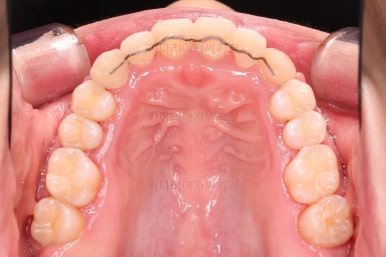 부산비발치교정