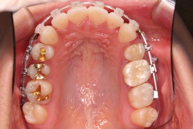 부산사랑니교정