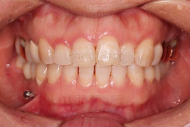 연산동부분교정