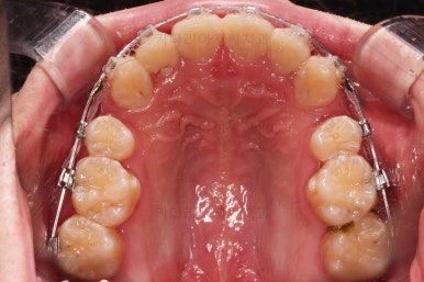 부산돌출입교정