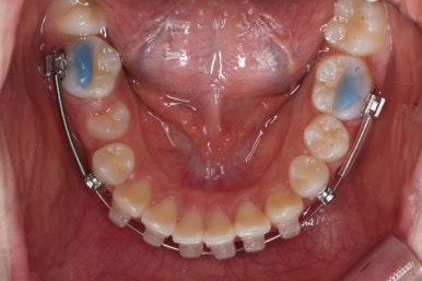 부산치아교정잘하는곳