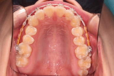 부산앞니부분교정