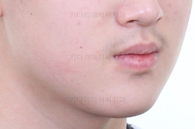 부산연산동사랑니발치