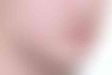 부산연산동사랑니발치