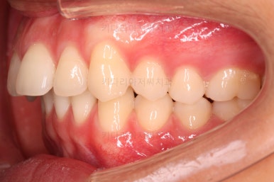 부산연산동치아교정