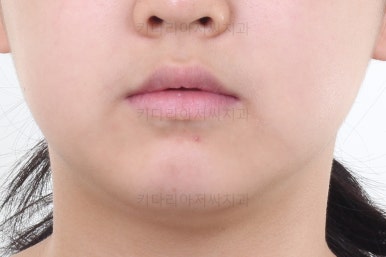부산토끼치아교정