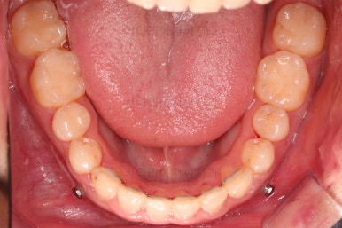 부산긴얼굴긴턱교정