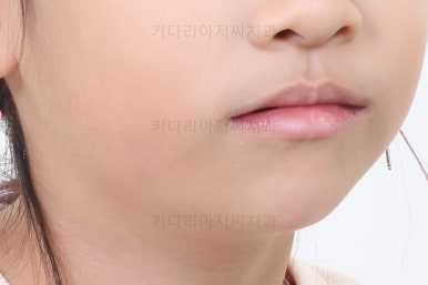 부산어린이치아교정