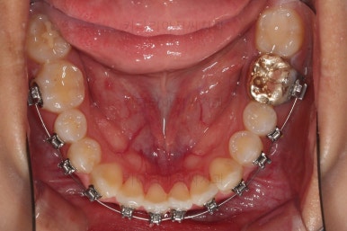 부산치아교정잘하는곳
