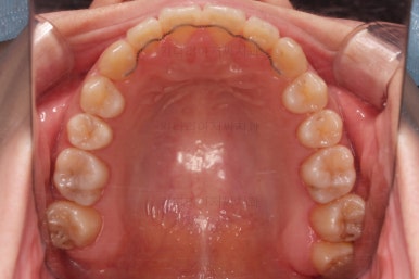 부산치아교정추천