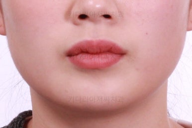 부산앞니부분교정