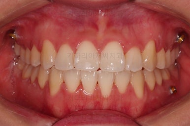 부산비발치교정