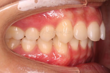 부산연산동치아교정