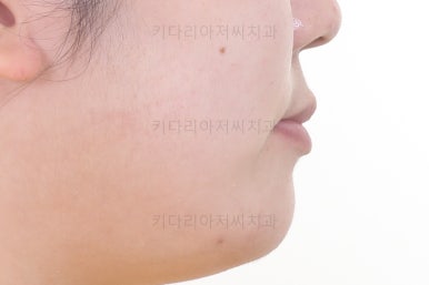 부산구순구개열