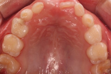 부산어린이치아교정