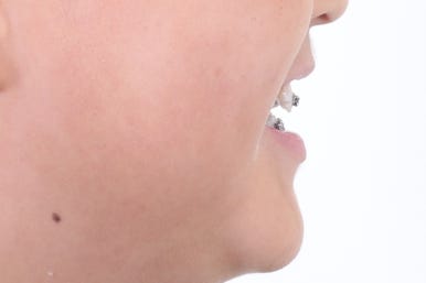 부산비발치교정