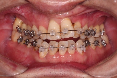 부산구순구개열교정