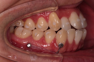 부산인비절라인