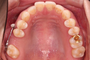 부산치아교정비용