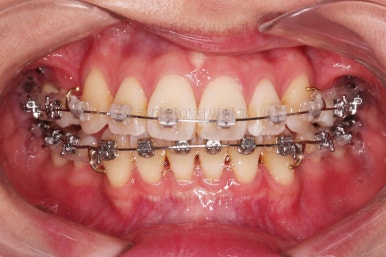 부산치아교정잘하는치과