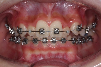 부산비발치교정