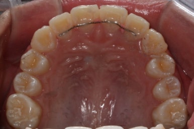 연산동덧니교정