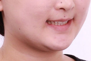 부산옥니교정