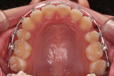 연산동치아교정