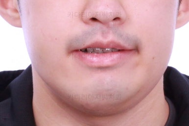 부산긴얼굴긴턱교정
