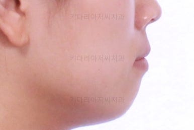 부산비발치교정