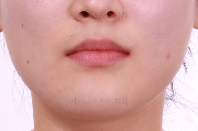 부산치아교정