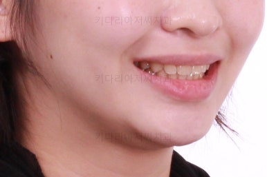 부산돌출입교정