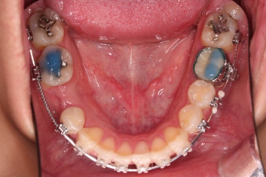 연산동치아교정