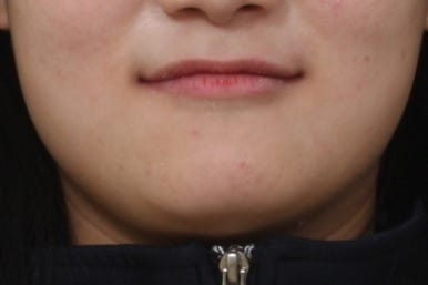 부산매복치아교정