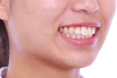 부산연산역치아교정