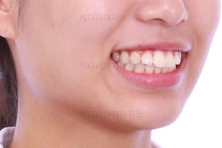 부산연산역치아교정