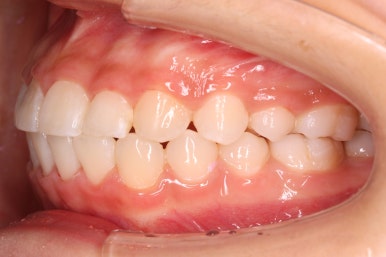 부산치아교정잘하는곳