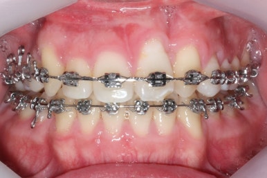 부산구순구개열