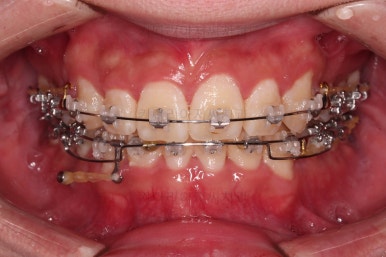 부산돌출입교정