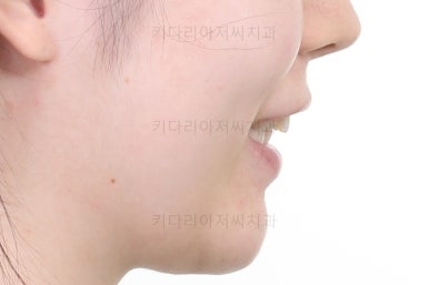 부산부분치아교정