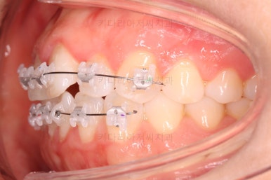 부산나비앞니교정