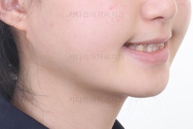 동래구치아교정