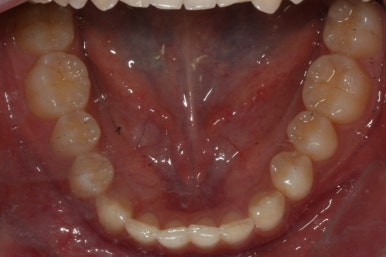 부산매복치아교정