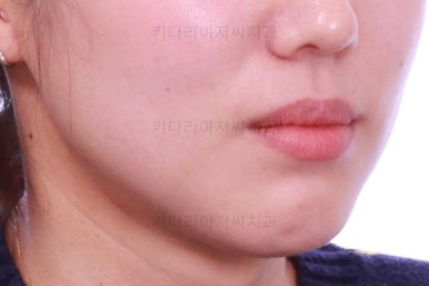 부산치아교정잘하는곳