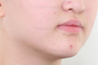 부산덧니교정