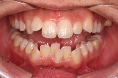 부산청소년치아교정