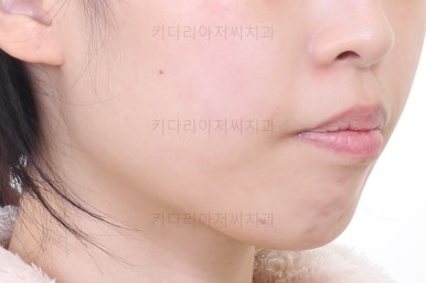 부산클리피씨교정